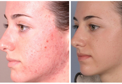 Acne Removal Treatment