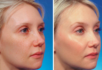 Carbon Laser Treatment