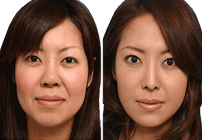 Face Slimming Treatment