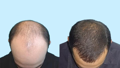 Stem Cell Therapy Treatment