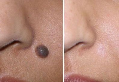 Mole Removal Treatment