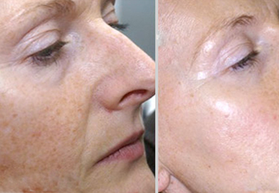 Photo Facial Treatment