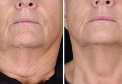IPL/ RF Treatment