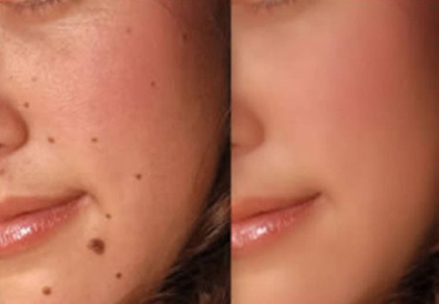 Scar, Wart Removal Treatment