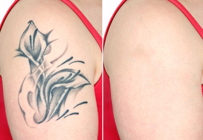 Tattoo Removal Treatment